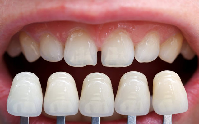 اگر لمینت های شما با دندان های شما همخوانی نداشته باشد چه اتفاقی می افتد؟