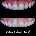 کانتورینگ دندان (تراشیدن مینای دندان) چیست؟