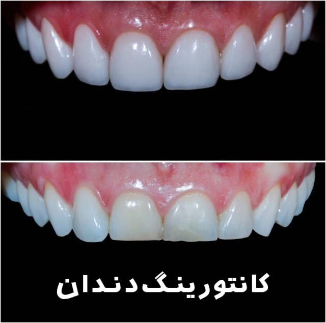 کانتورینگ دندان (تراشیدن مینای دندان) چیست؟