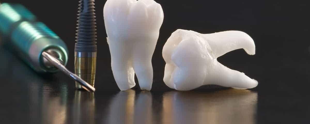 مراحل ساخت روکش دندان در لابراتور