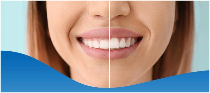 مزایا و معایب کانتورینگ دندان