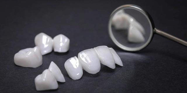 سوالات متداول در مورد نحوه ساخت روکش‌های دندانی