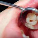 نحوه تشخیص عفونت روکش دندان و اقدامات درمانی