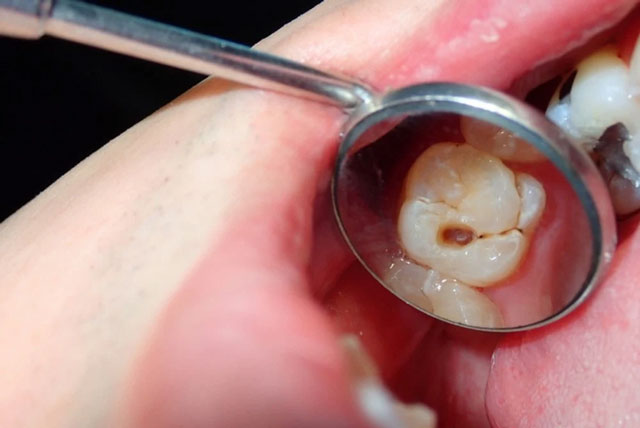 نحوه تشخیص عفونت روکش دندان و اقدامات درمانی