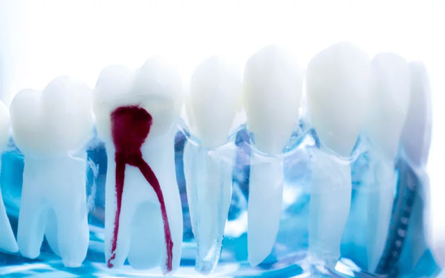 عصب کشی دندان چقدر طول میکشد؟