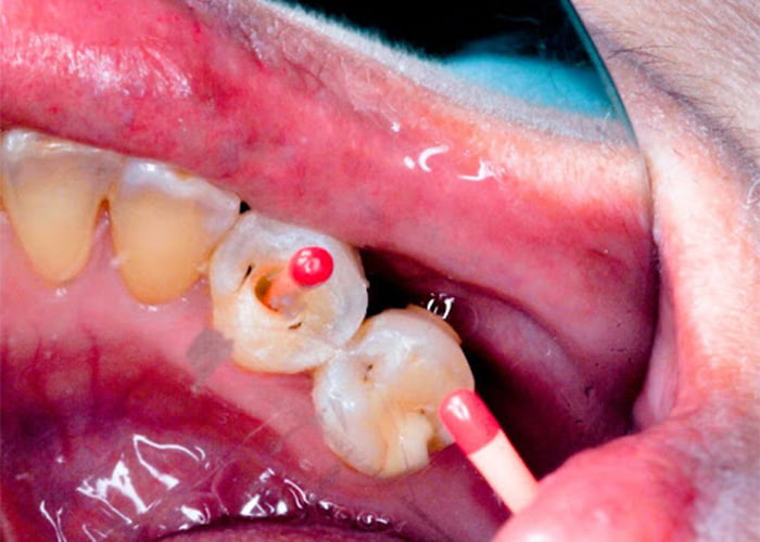 عصب کشی دندان چقدر طول میکشد؟