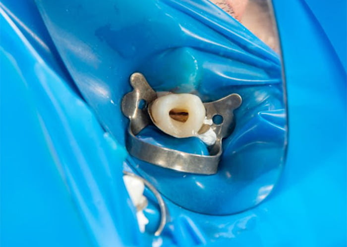 درمان ریشه دندان شامل چه مواردی است؟