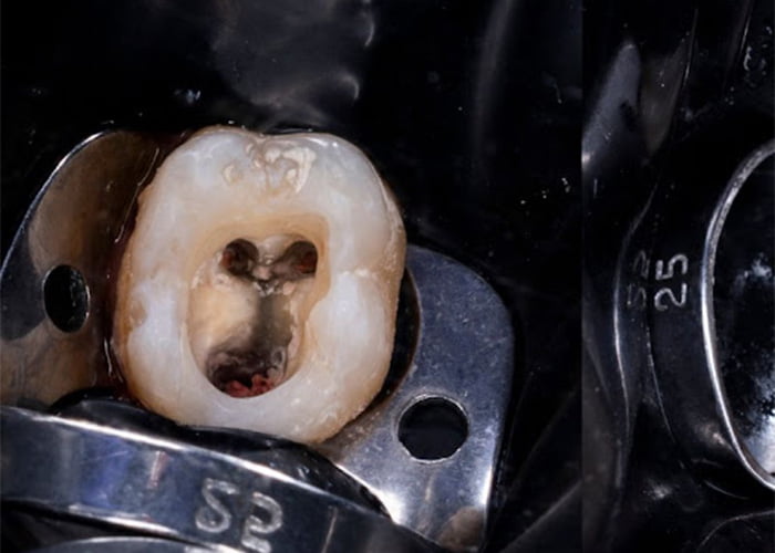 چه مدت طول میکشد تا عصب کشی دندان انجام شود؟