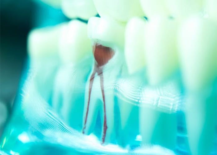 چرا عصب کشی دندان نیاز به دو ویزیت دارد؟