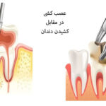 عصب کشی یا کشیدن دندان؟