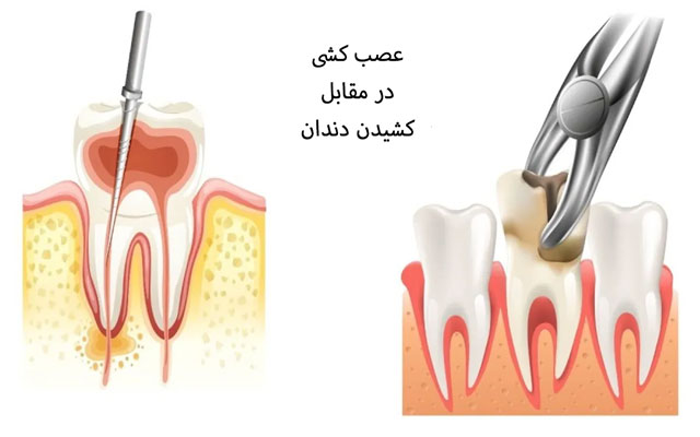 عصب کشی یا کشیدن دندان؟
