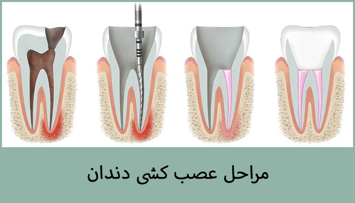 روش گام به گام انجام عصب کشی دندان