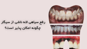 رفع سیاهی لثه ناشی از سیگار