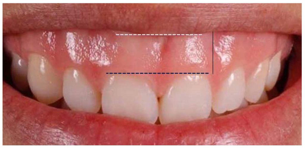 واجد الشرایط بودن برای جراحی لبخند لثه ای