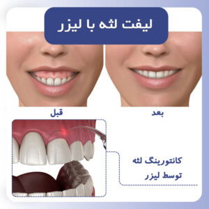 لیفت لثه با لیزر | کانتورینگ لثه با لیزر