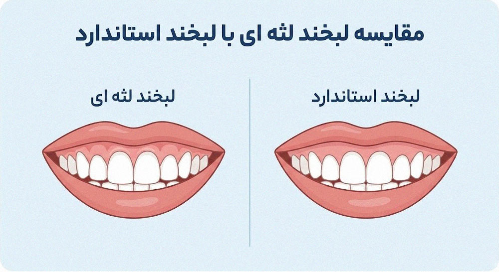 مقایسه لبخند لثه‌ای با لبخند استاندارد قبل و بعد از لیفت لثه با لیزر