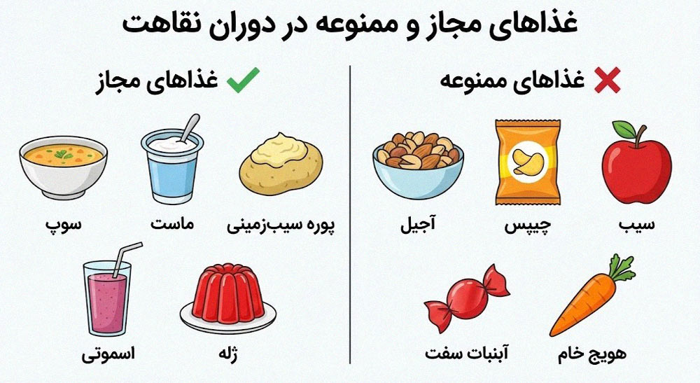 رژیم غذایی بعد از لیفت لثه با لیزر - غذاهای مجاز و ممنوعه