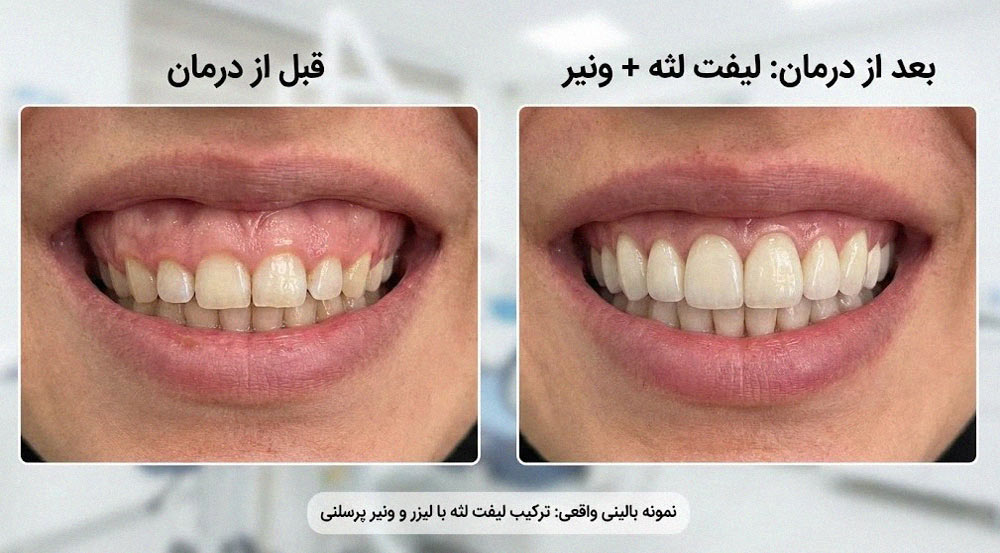  ترکیب لیفت لثه با لیزر و نصب ونیر پرسلنی روی دندان های یک بیمار واقعی