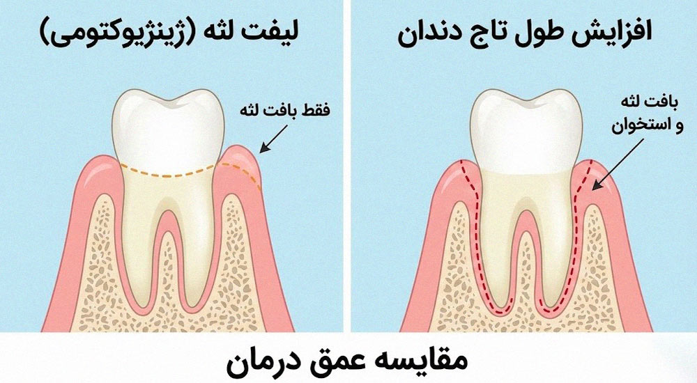 تفاوت لیفت لثه با لیزر و افزایش تاج دندان با لیزر