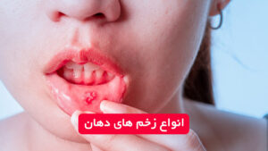انواع زخم دهان همراه با تصویر