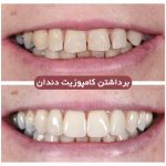 ریمو کامپوزیت دندان