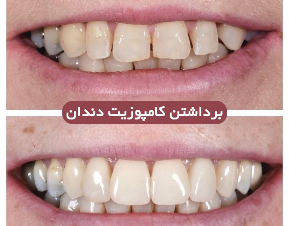 ریمو کامپوزیت دندان