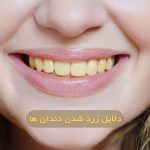 زرد شدن دندان ها