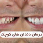 درمان دندان های کوچک