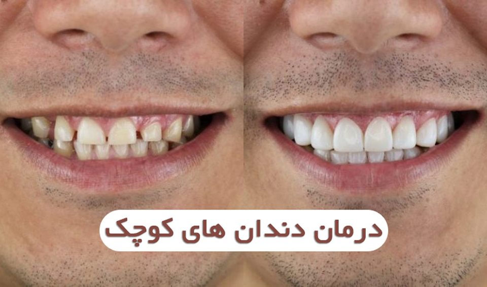 درمان دندان های کوچک