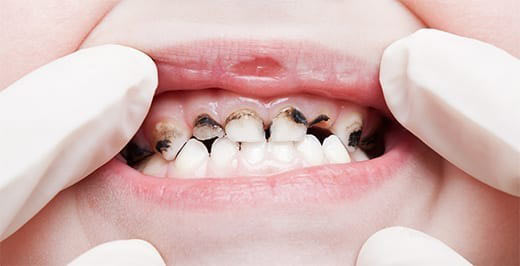 پوسیدگی زودرس دندان کودکان