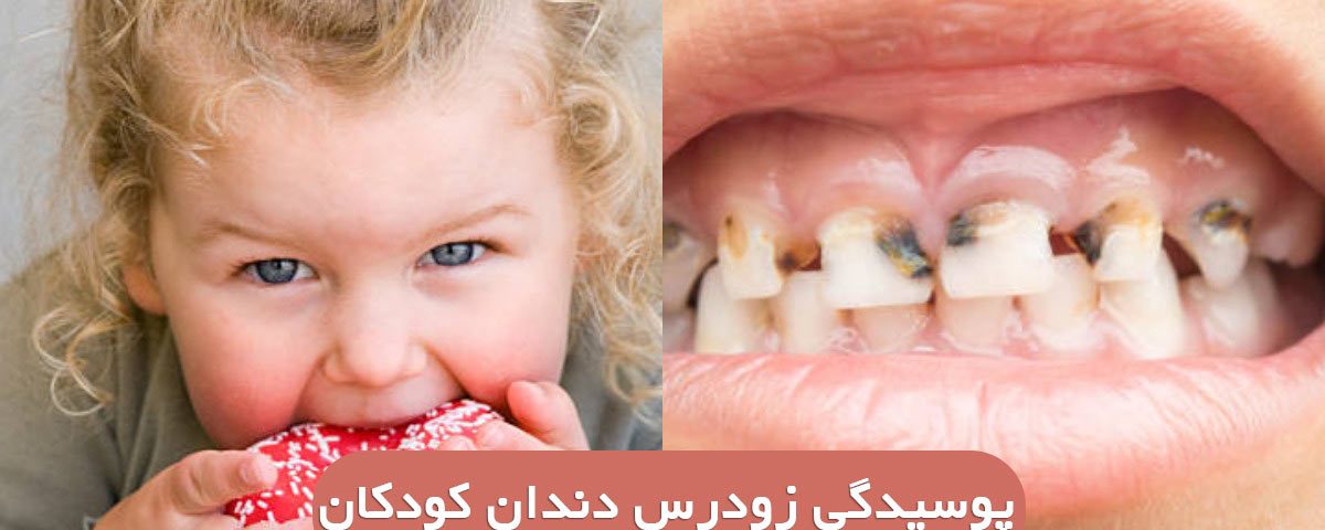پوسیدگی های اولیه (زودرس) دندان دوران کودکی