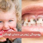 پوسیدگی های اولیه (زودرس) دندان دوران کودکی