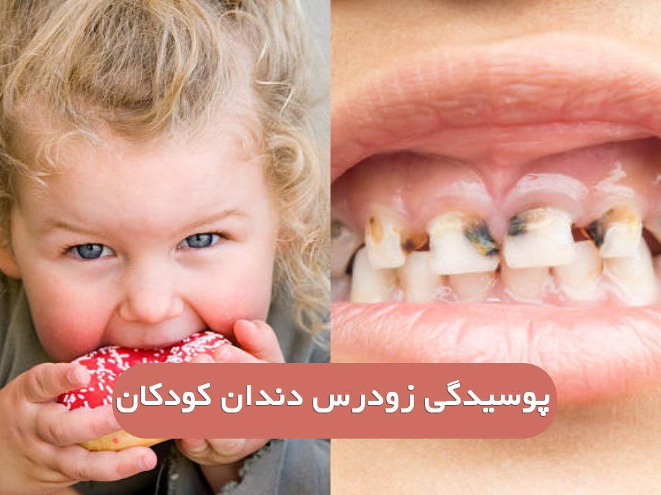 پوسیدگی های اولیه (زودرس) دندان دوران کودکی