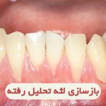 رشد لثه تحلیل رفته چگونه انجام میشود؟