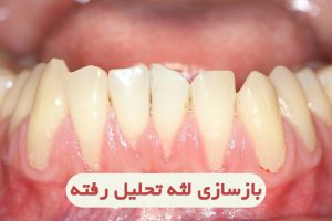 رشد لثه تحلیل رفته چگونه انجام میشود؟