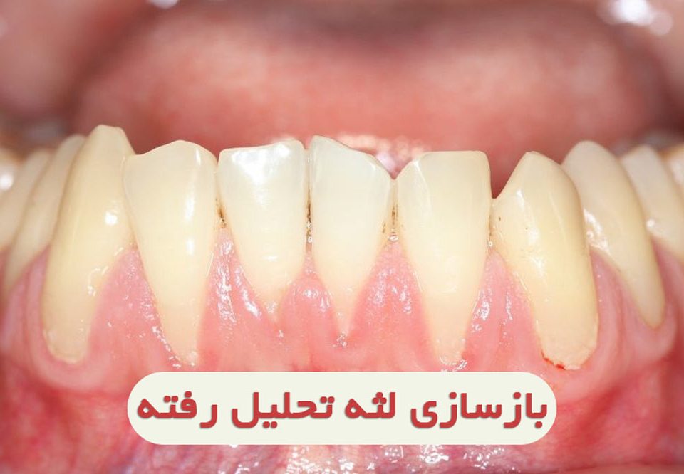 رشد لثه تحلیل رفته چگونه انجام میشود؟