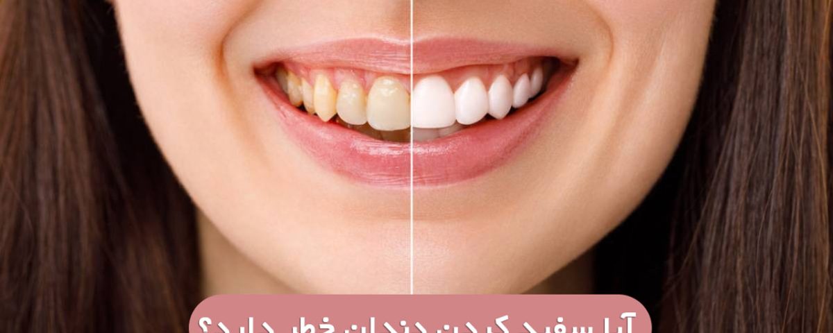 آیا سفید کردن دندان(بلیچینگ) به دندان ها آسیب میزند؟