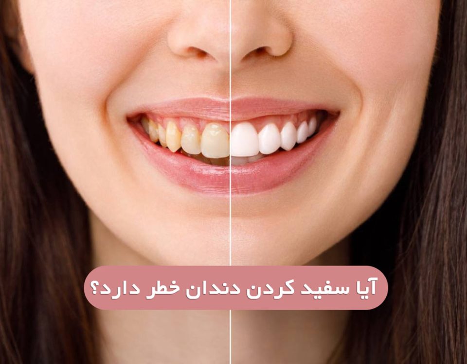 آیا سفید کردن دندان(بلیچینگ) به دندان ها آسیب میزند؟