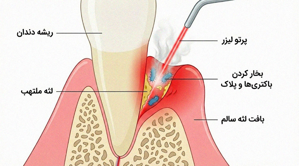 جرم گیری دندان با لیزر