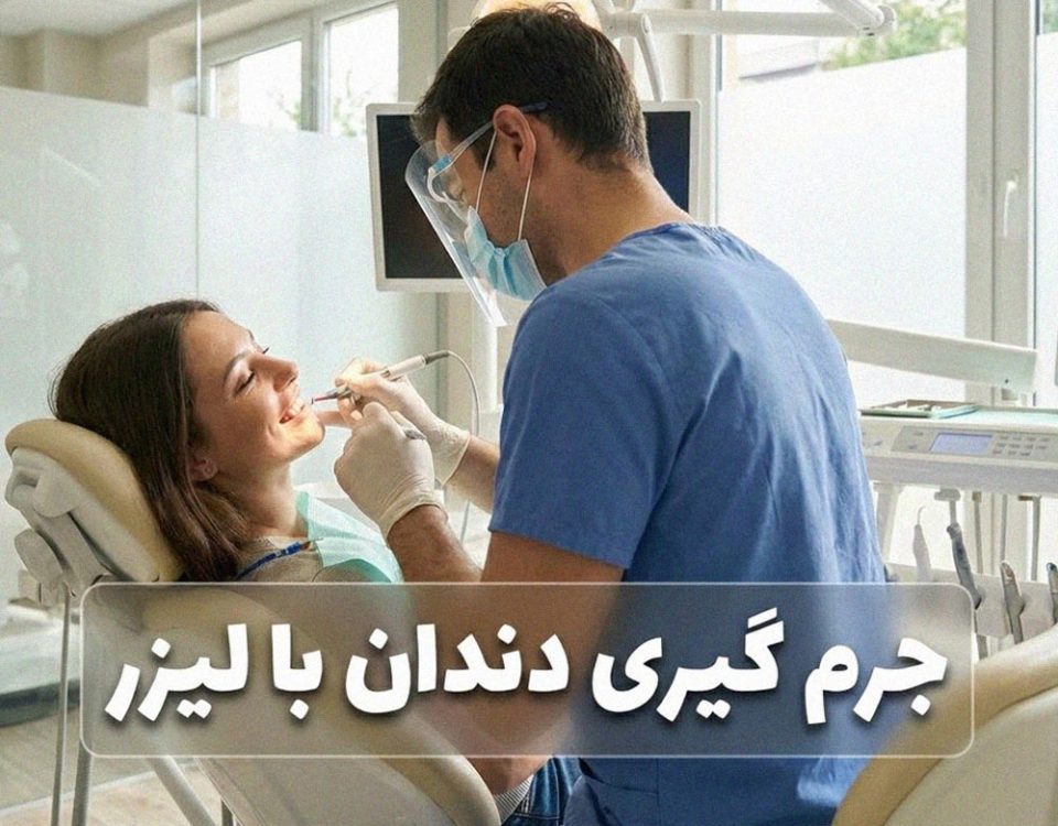 جرم گیری دندان با لیزر