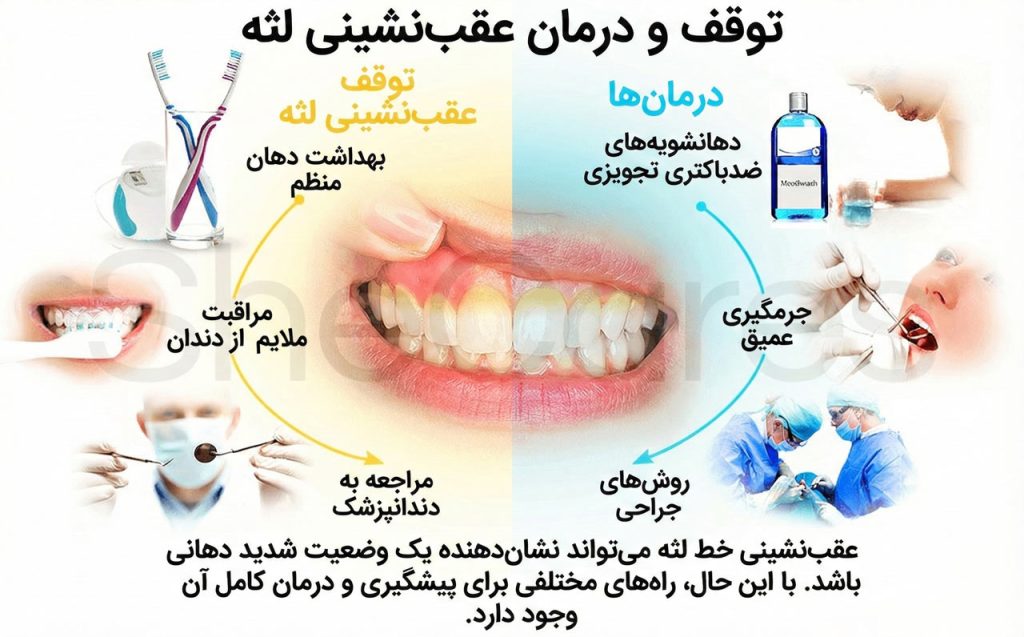 مراقبتهای خانگی در پیشگیری از تحلیل لثه