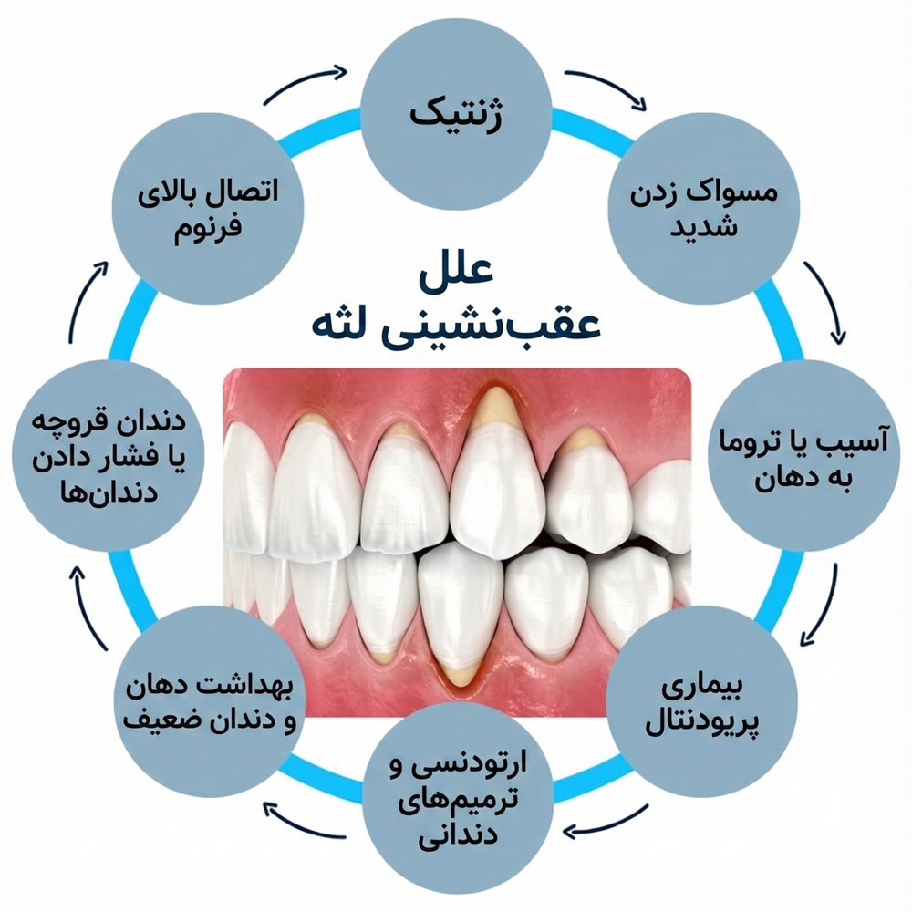 علل تحلیل لثه