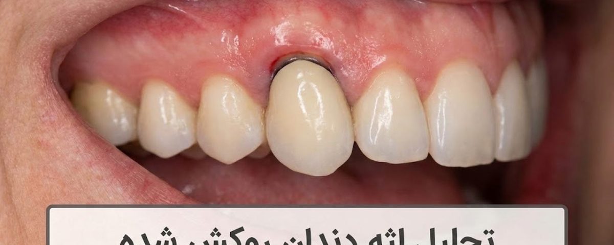 تحلیل لثه دندان روکش شده