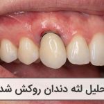 تحلیل لثه دندان روکش شده