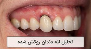 تحلیل لثه دندان روکش شده