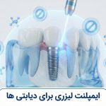 کاشت ایمپلنت دندان برای افراد دیابتی با لیزر