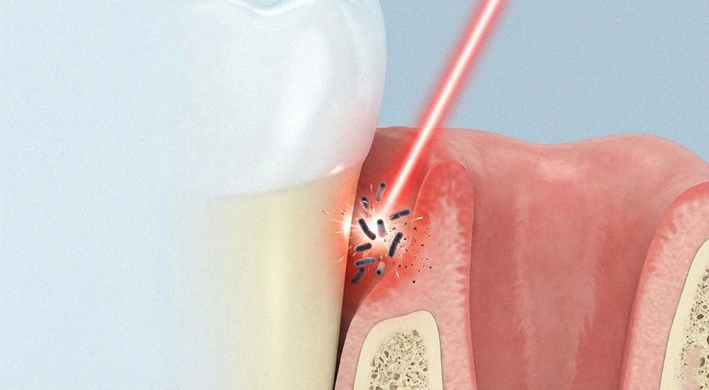 تصویر شماتیک درمان پاکت لثه با لیزر دندانپزشکی و از بین بردن باکتری‌ها