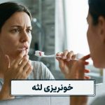 خونریزی لثه