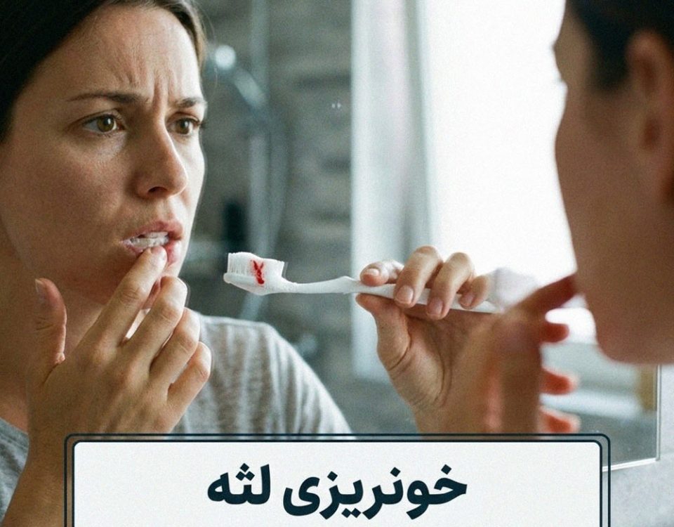 خونریزی لثه