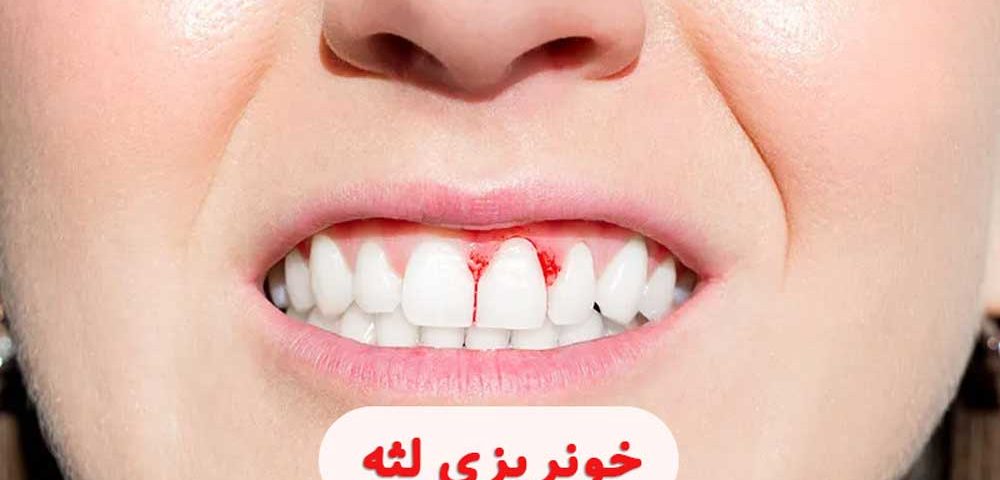 خونریزی لثه